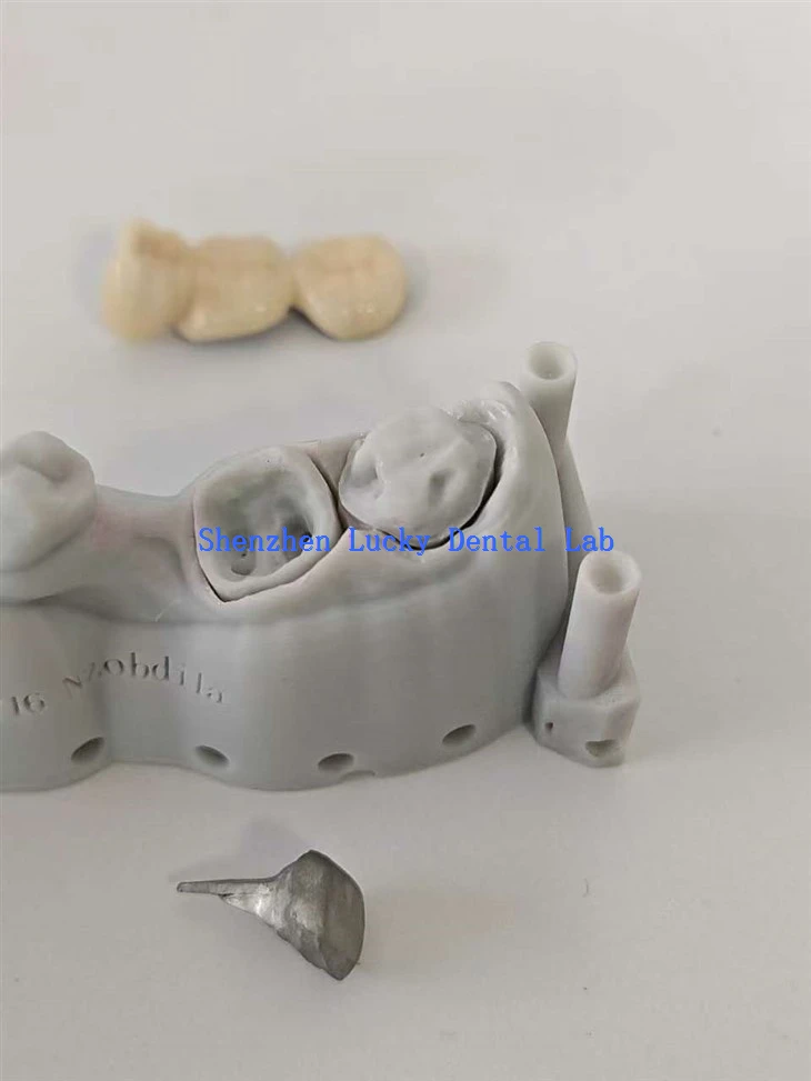 Přizpůsobený 3D tisk PFM COCR Bridge s Post Core Dental Lab