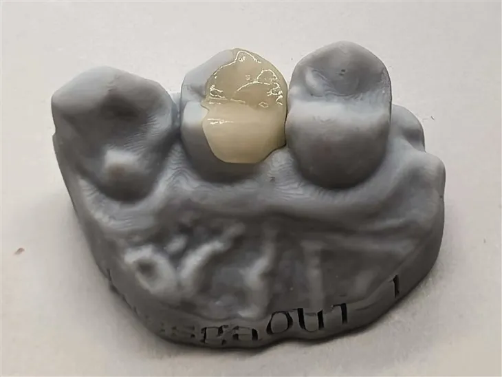 Autentický kompozitní Onlay za lepší cenu