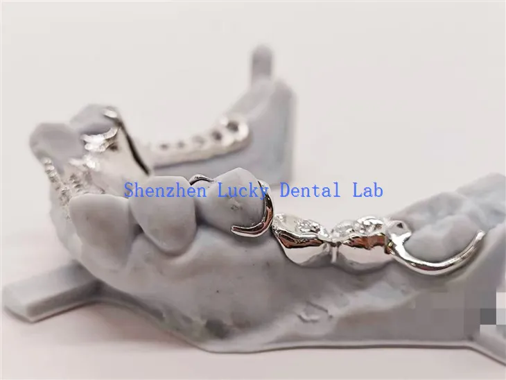 Kovový rámec s designem zubů pod zálohováním slitiny